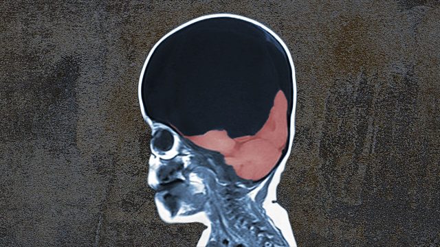 日益严峻的狂犬病形势——意想不到的病毒