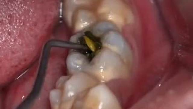 牙齿里面藏了一桌酒席