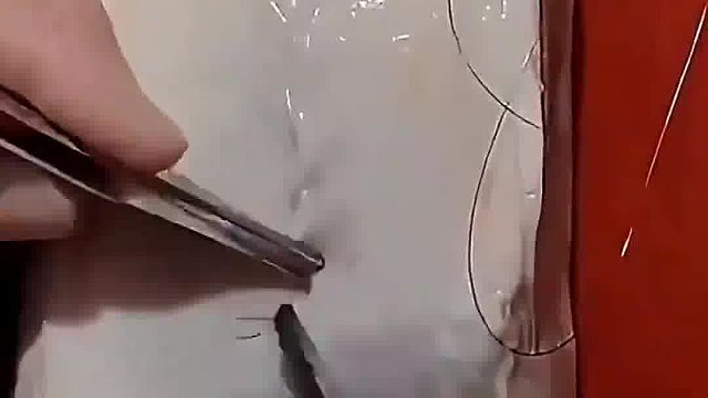 整形科医生基本功，皮肤根本没有缝合痕迹，技术直接秒杀韩国医美！