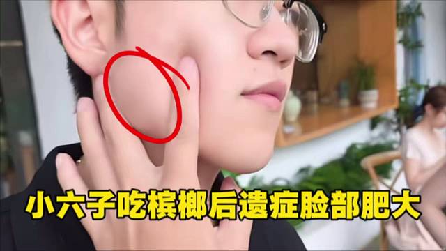 小六子吃槟榔后遗症脸部肥大，核桃大的咬肌。
