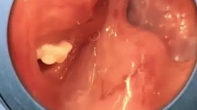 清除扁桃体结石