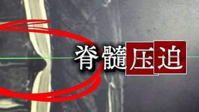 不动手术最终就是瘫痪，捉捉又要渡劫了。