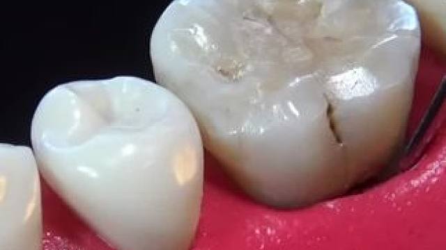 来了解一下牙疼的根源#解压 #拔牙