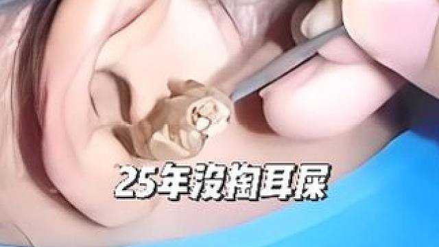 女子25年没掏耳屎， 医生挖出2坨“巨无霸” 