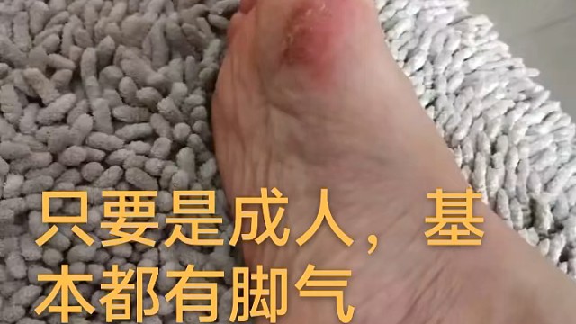 看上去是脚气
