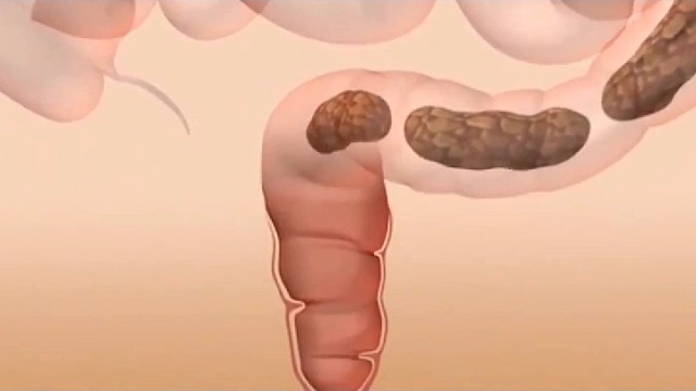 帕金森便秘如何缓解？