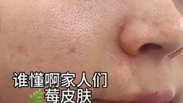 #和素颜和解 #拒绝草莓鼻