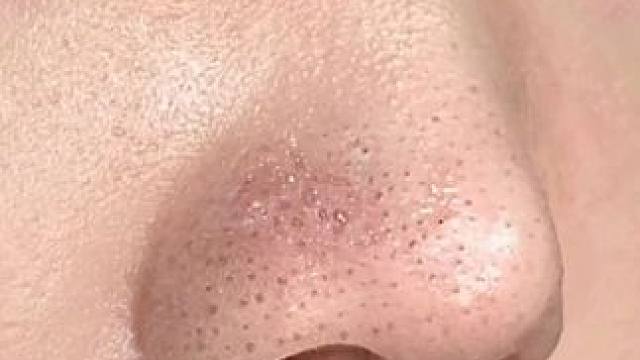 #拒绝草莓鼻 #前后对比