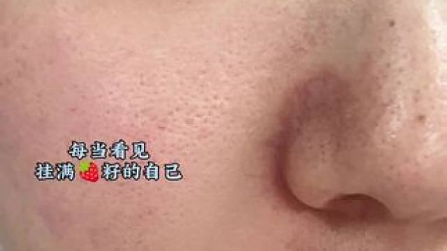 #拒绝草莓鼻 #前后对比