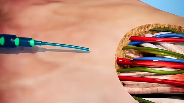 动物注射静脉也会产生遗漏。