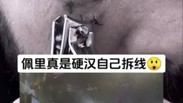 佩里真是硬汉自己拆线