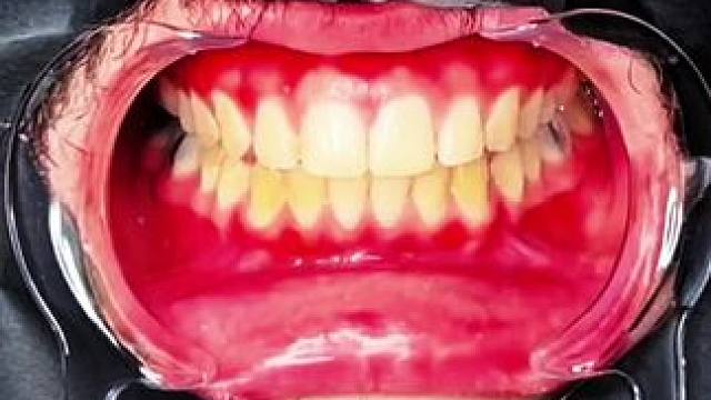 牙齿也有素颜霜了，产品的原理就是黄色和紫色中和变成白色，非永久性的哦  #牙齿美白 #hismile