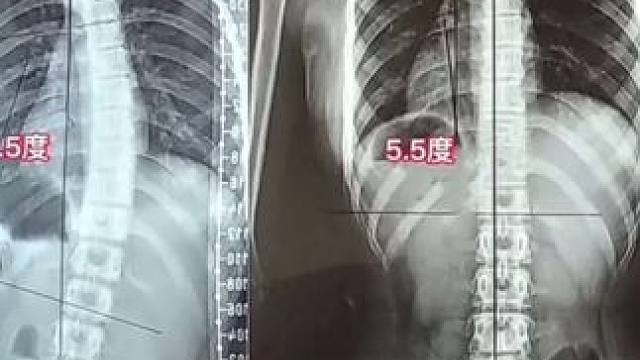 儿子个子不高，学习是总有些塌腰驼背，妈妈每晚睡前给他躺上3分钟，及时纠正！将来不留遗憾，简单的动作重