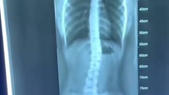 孩子总是弯腰驼背，你一定要让他试着这个动作，坚持一段时间，你会发现#驼背改善了 #体态挺拔了#个字也