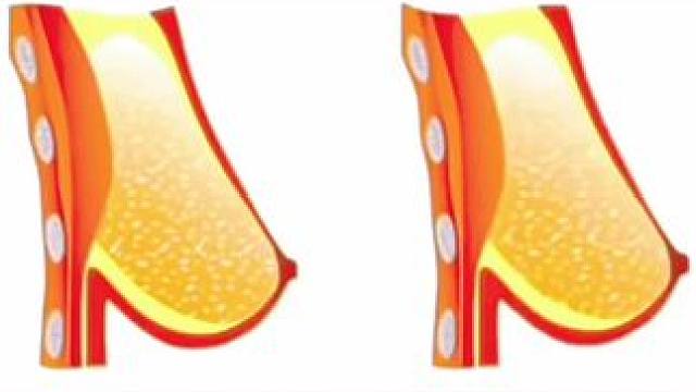 每天200个，背薄了，手臂细了，身材变好了，气质提升了，副乳也消失了