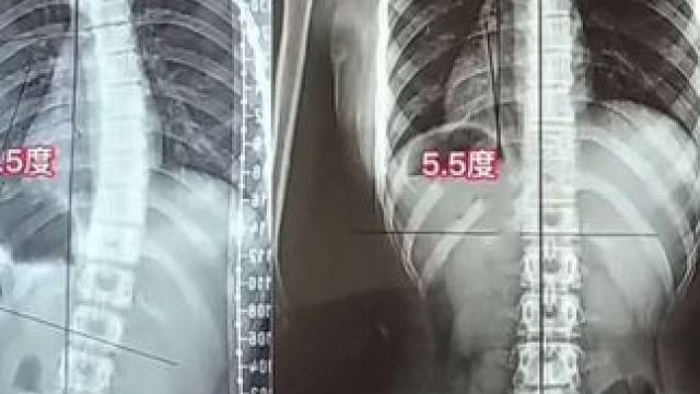 女儿个子不高，学习是总有些塌腰驼背，妈妈每晚睡前给他躺上3分钟，及时纠正！将来不留遗憾，简单的动作重