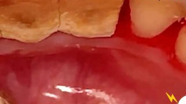 强迫症福音：解压洗牙过程，大爷第一次感受并给予肯定 #洗牙 #牙齿 #牙齿健康 #口腔科普 #口腔健