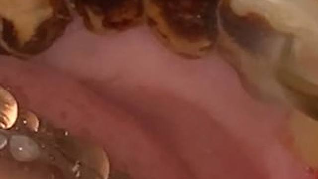 强迫症福音：十几年黑色牙石，轻轻松松清理干净 #牙结石完整去除 #口腔科普 #牙齿 #爱护牙齿 #解