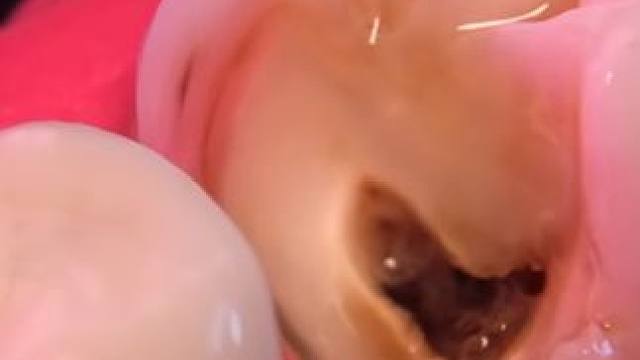 牙齿烂了个大洞，该如何修补呢#解压 #补牙