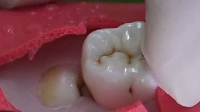 智齿是拔还是留，那得看你的智齿是怎么长的#解压 #拔牙 #智齿