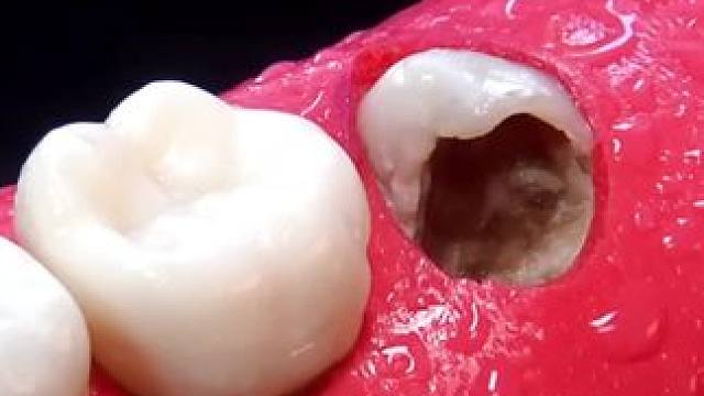 智齿居然烂了个大洞，真是双重折磨#解压 #补牙 #智齿