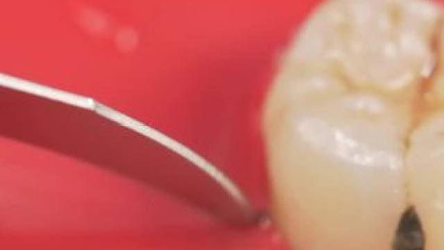 是谁还饱受智齿的折磨#解压 #拔牙 #智齿