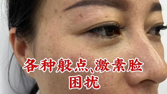 素颜大师祛斑秘籍，轻松拥有无瑕肌肤