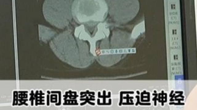 #腰椎 #腰椎间盘突出 #腰疼腿疼 #屁股麻 #骨科专家尹辛成