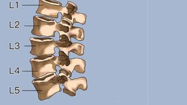 #腰椎 #腰椎间盘突出 #腰疼腿麻 #骨科专家尹辛成