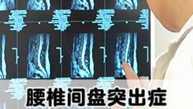 #腰椎 #腰椎间盘突出 #腰疼腿疼 #中医中药 #手术