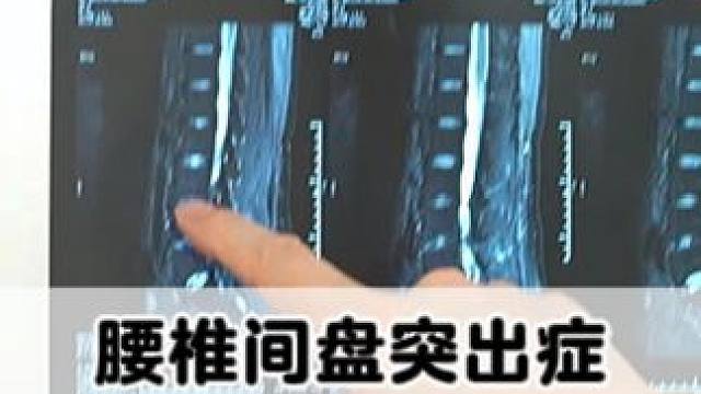 #腰椎 #腰椎间盘突出 #腰疼腿疼 #诊室日常 #骨科专家尹辛成