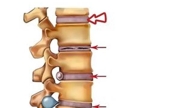 腰椎间盘相关症状，你是哪个？ #腰椎 #腰椎间盘突出 #腰椎间盘膨出 #腰疼腿疼 #骨科专家尹辛成
