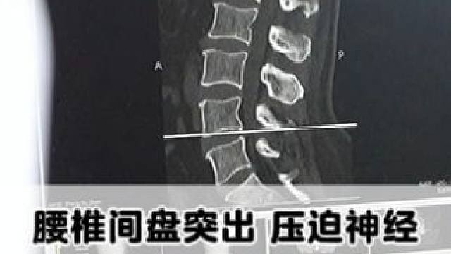 #腰椎 #腰椎间盘突出 #腰疼腿疼 #中医中药 #医学科普