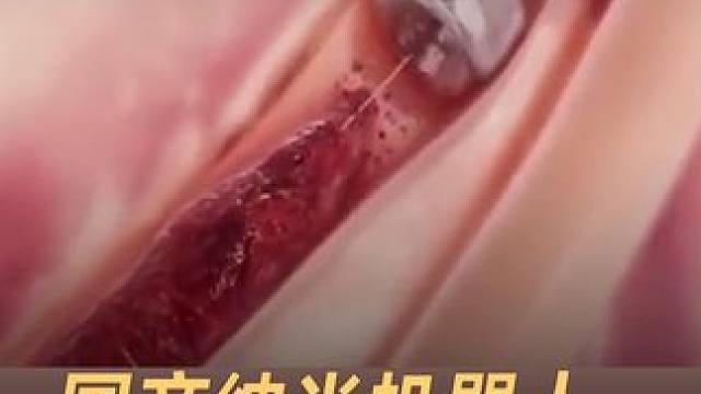国产纳米机器人，不开刀6分钟打通血栓#中国  #纳米机器人  #科技强国  #哈工大 #科技改变生活