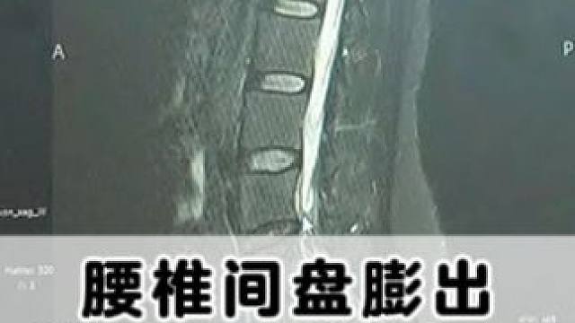 #腰椎 #腰椎间盘膨出 #腰疼腿疼 #诊室日常 #骨科专家尹辛成