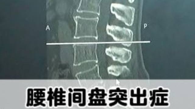 #腰椎 #腰椎间盘突出 #腰疼腿疼 #诊室日常 #骨科专家尹辛成