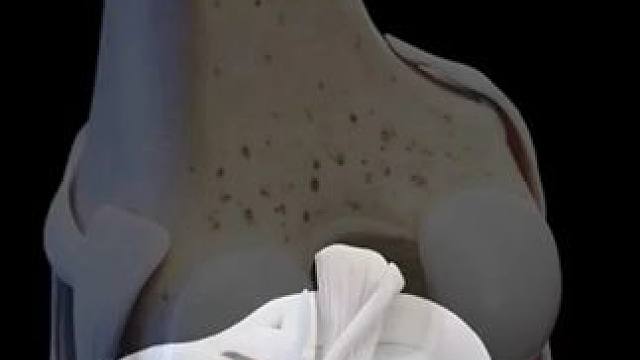 #半月板 #骨科 #医学健康 #膝盖 #膝盖疼