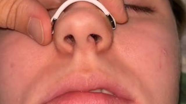 #止鼾 #止鼾器 #睡觉打呼噜 #打呼噜怎么治