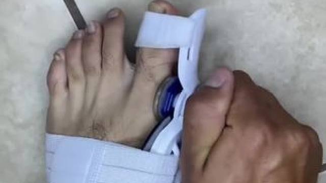 #脚趾矫正器 脚趾矫正器，拇指外翻纠正，男女士大脚骨脚指内翻分趾器 #拇指外翻  #轻度拇指外翻怎么