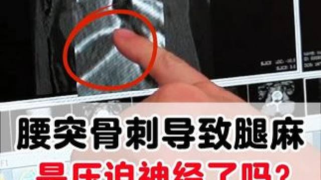 腰椎间盘突出有骨刺，压迫神经导致腿麻#腰突 #腰椎间盘突出 #腿麻 #压迫神经 #腿木