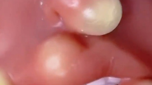 挤痘痘解压玩具。