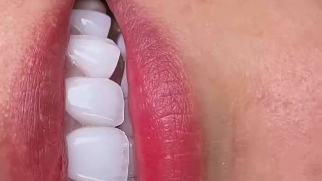 超薄超透牙齿贴面