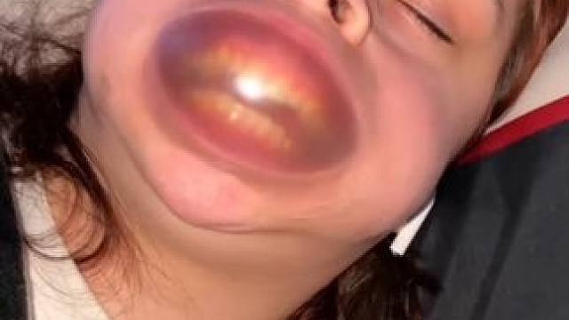 止鼾