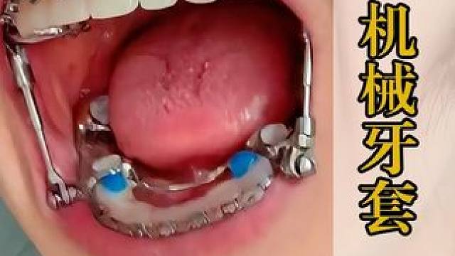 为什么要往牙齿里安个嘎吱嘎吱响的金属杆？ #科普 #涨知识 #牙齿正畸 #牙套