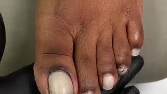 #修脚#美甲#甲沟炎