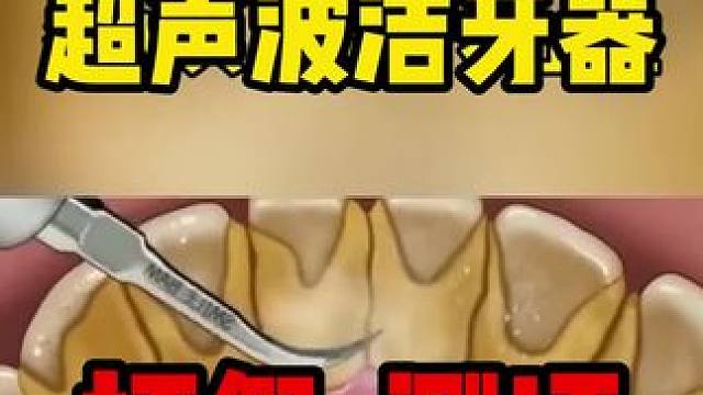 这个超声波洁牙器确实挺好用啊