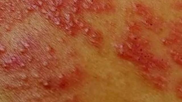 张靓颖自曝健康红灯！带状疱疹留疤脚踝积液复发成“单脚战士”