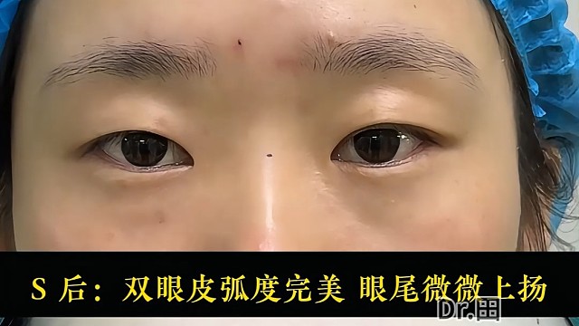 秒变双眼皮