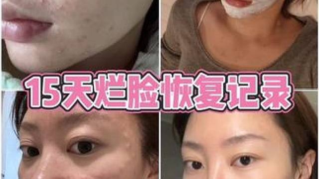 为期半个月抗豆全过程大记录！（超真实版 #抗痘历程 #变美 #纯分享 #韩国皮肤科 #vlog