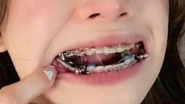 牙套是怎么矫正牙齿的？